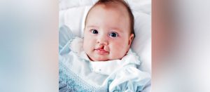 Cleft lip and palate surgery