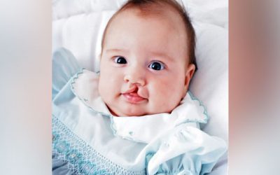 What is the Cleft Lip and Palate Surgery Timeline?